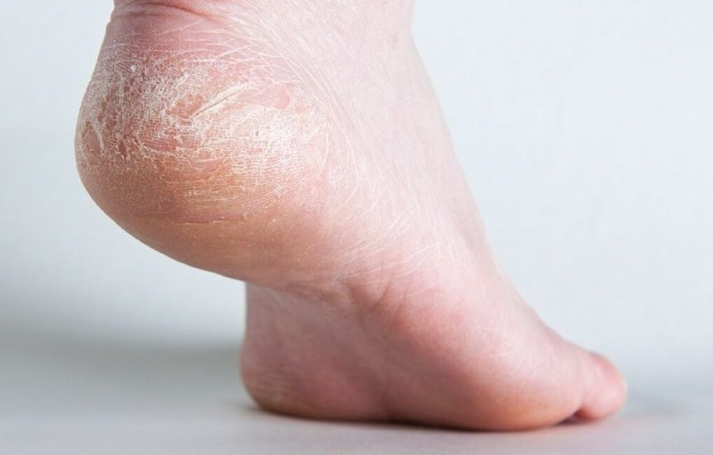 champignon de la peau sur la jambe comment traiter