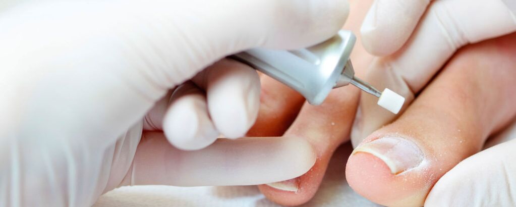 Couper la couche supérieure de l'ongle