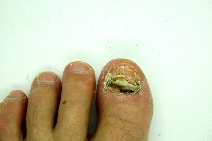 Fungus à ongles de doigt - scène lourde