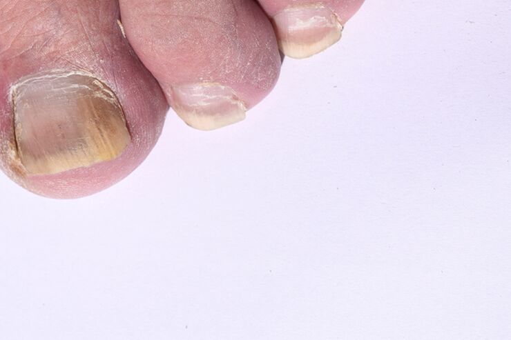 Le stade initial de la mycose des ongles sur les jambes