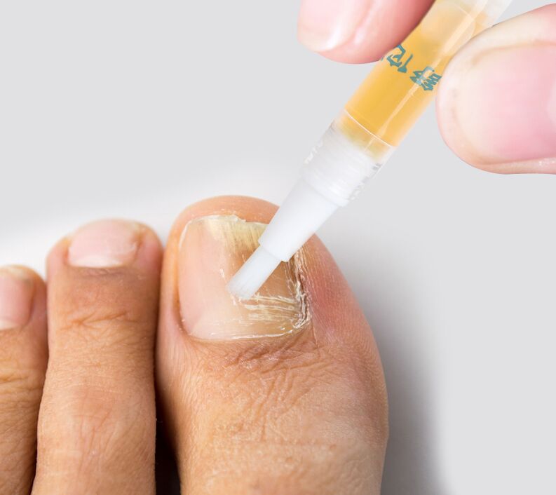 liquide contre la mycose des ongles des pieds