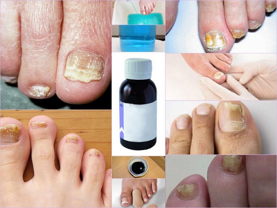 médicaments contre la mycose des ongles des pieds