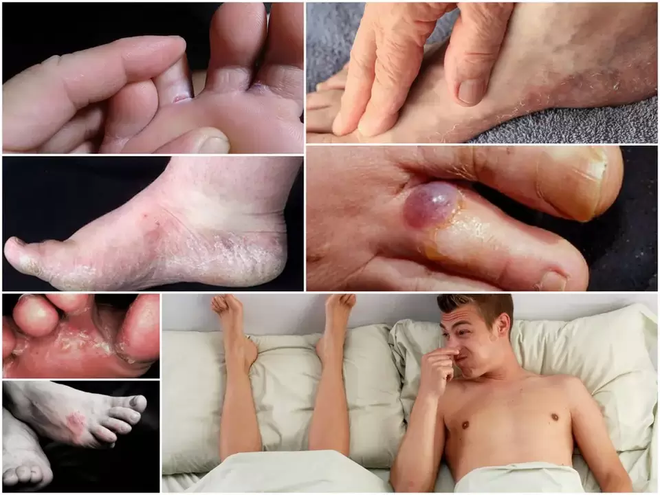 Principaux signes de mycose du pied