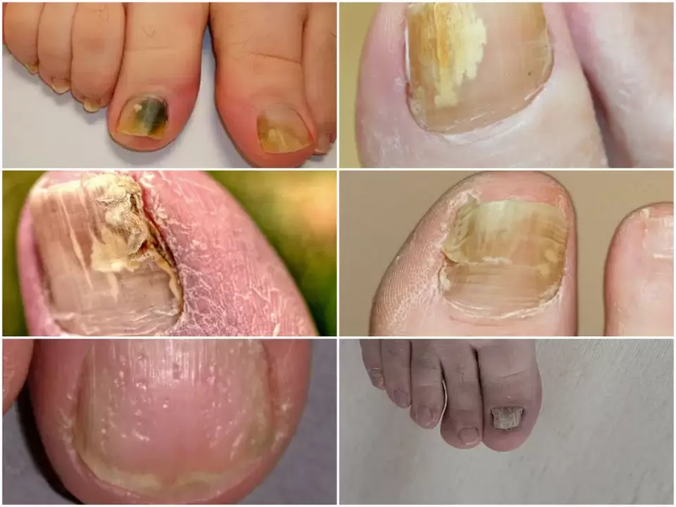 Symptômes de l'onychomycose - changements dans la couleur et la structure des ongles