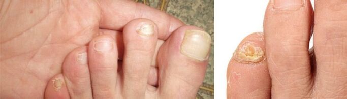 photo de manifestations de champignons sur les ongles des pieds