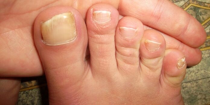 dommages aux ongles des pieds avec des champignons